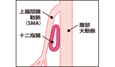 嘔吐や腹痛、消化物通過しにくい～腸が血管に挟まれる―ＳＭＡ症候群（筑波大学付属病院　後藤悠大医師）～