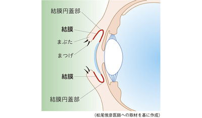 長期の経過が明らかに～結膜リンパ腫（岡山大学学術研究院　松尾俊彦教授）～