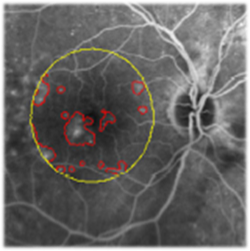   sina farsiu automatic  segmentation Hossein Rabbani fluorescein angiography (FA) Diabetic Retinopathy Diabetic macular edema DME