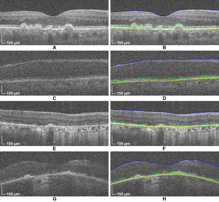 drusen geographic atrophy chiu farsiu sina segmentation automatic