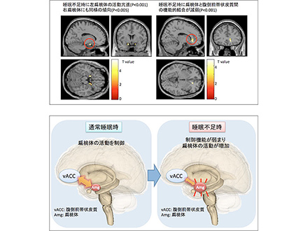 睡眠不足で情動不安定や抑うつに