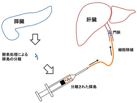 膵島移植に有用な酵素カクテルを開発