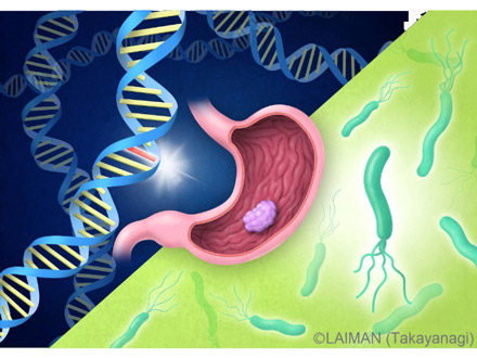 胃がんリスク「ピロリ×遺伝」で大幅に高まる 理研など解明
