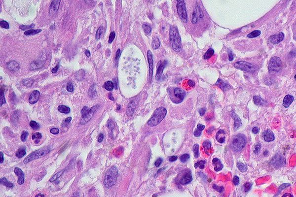 近年、薬に対する真菌の耐性が強まっている、英の研究者らが警鐘を鳴らす